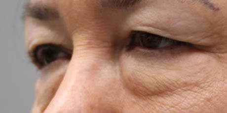 1_0010_Pt 1 before asian bleph – left side.JPG