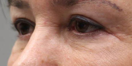 1_0011_Pt 1 after asian bleph – left side.JPG
