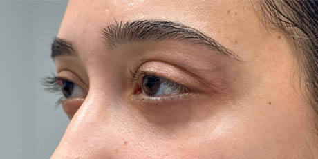 1_0011_patient 3 after lower bleph with facial fat grafting to lower lids and mid-face (side).PNG