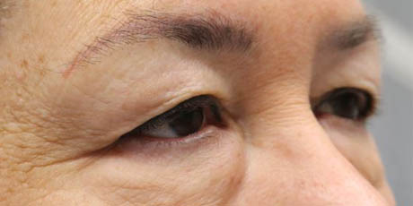 1_0012_Pt 1 before asian bleph – right side.JPG