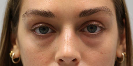 1_0012_patient 6 before lower bleph with facial fat grafting to lower lids and mid-face.PNG