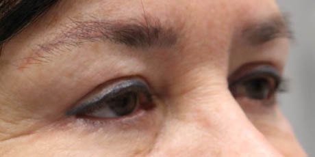 1_0013_Pt 1 after asian bleph – right side.JPG