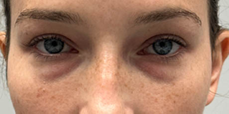 1_0014_patient 7 before lower bleph facial fat grafting to lower lids and mid-face.PNG