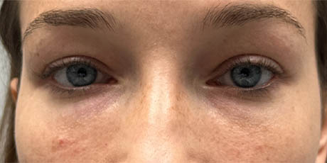 1_0015_patient 7 after lower bleph facial fat grafting to lower lids and mid-face.PNG