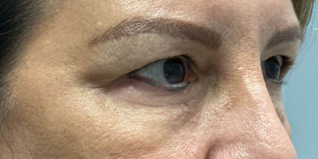 1_0016_patient 8 before quad bleph with facial fat grafting to brows, lower lids and mid-face–side.JPG
