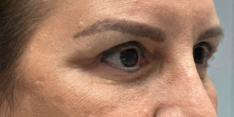 1_0017_patient 8 after quad bleph with facial fat grafting to brows, lower lids and mid-face–side.JPG