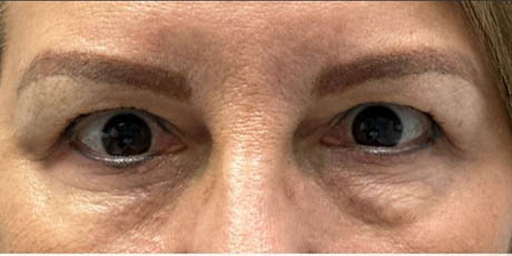 1_0018_patient 8 before quad bleph with facial fat grafting to brows, lower lids and mid-face.JPG