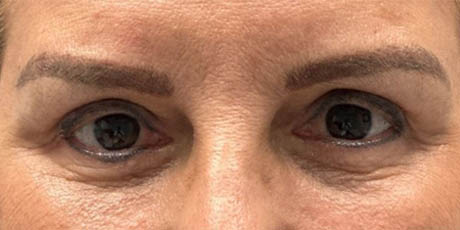 1_0019_patient 8 after quad bleph with facial fat grafting to brows, lower lids and mid-face.JPG