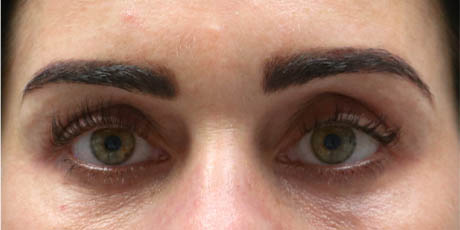 1_0021_patient 9 after lower bleph with facial fat grafting to lower lids and mid-face.jpg