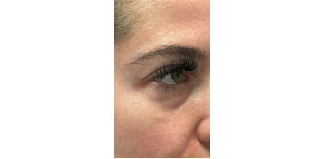 1_0022_patient 55 before lower bleph with facial fat grafting to lower lids and mid-face.JPG