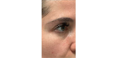 1_0023_patient 55 after lower bleph with facial fat graftingto lower lids and mid-face.JPG