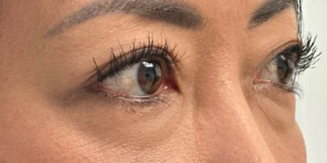 1_0024_patient 57 before lower bleph with facial fat grafting to lower lids and mid-face.JPG