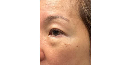 1_0026_patient 102 before lower bleph with facial fat grafting to lower lids and mid-face.JPG