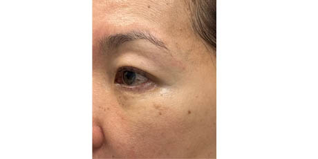 1_0027_patient 102 after lower bleph with facial fat grafting to lower lids and mid-face.JPG