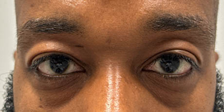 1_0028_pt 24 before lower bleph with far grafting front to lower lids and mid-face.jpg