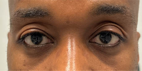 1_0029_pt 24 after lower bleph with far grafting front to lower lids and mid-face.jpg
