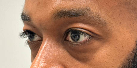 1_0030_pt 24 before lower bleph with far grafting side to lower lids and mid-face.jpg