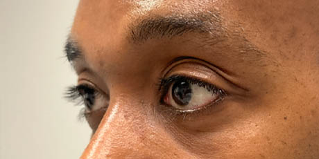1_0031_pt 24 after lower bleph with far grafting side to lower lids and mid-face.jpg