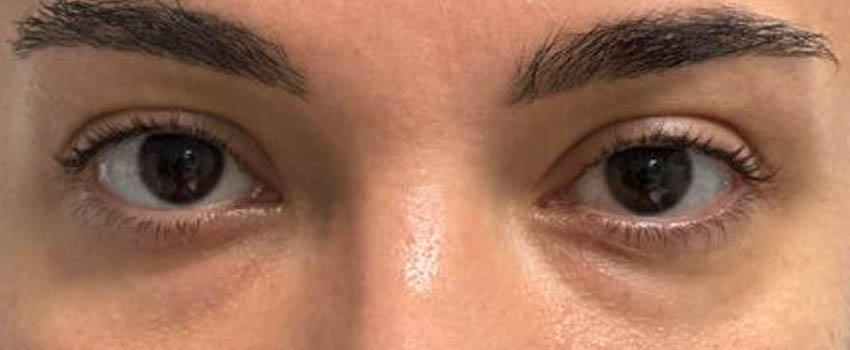 1_0000_AS-Before Eyes PRP 1 TREATMENT.JPG