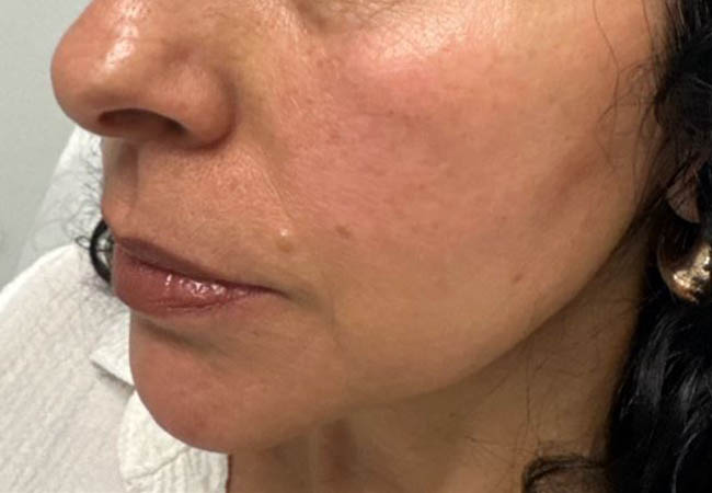 1_0000_BY BONNIE patient 1 before chin and jawline contour.JPG