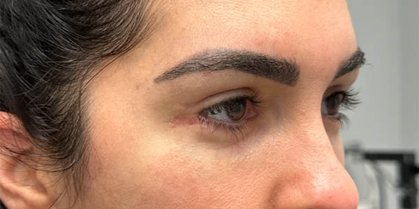 1_0000_patient 1 after Revision Bilateral Lower Blepharoplasty with Canthoplasty, Hard Palate Grafts, Midface Lift, Ptos