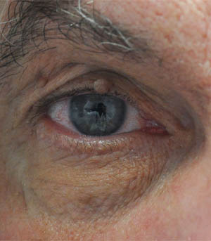 1_0000_patient 10 before lesion removal.jpg
