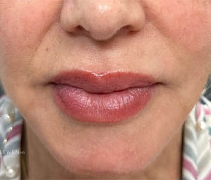 1_0000_patient 11 after filler lips and around the mouth.png