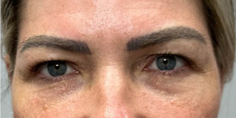 1_0000_patient 4 before upper bleph with temporal brow lift, fat grafting to brows and peri-orbital CO2 (front).png