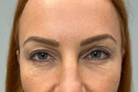 1_0000_patient 40 after upper bleph, ptosis repair and subbrow filler – front.png