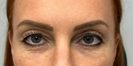 1_0000_patient 40 before upper bleph, ptosis repair and subbrow filler – front.png