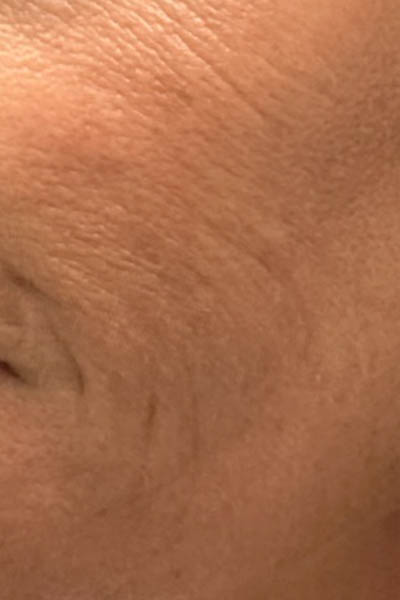 1_0000_patient 6 before microneedling with PRP.PNG