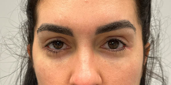 1_0001_patient 1 after Revision Bilateral Lower Blepharoplasty with Canthoplasty, Hard Palate Grafts, Midface Lift, Ptos