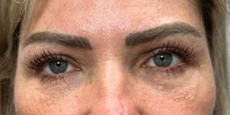 1_0001_patient 4 after upper bleph with temporal brow lift, fat grafting to brows and peri-orbital CO2 (front).png
