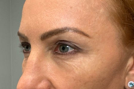 1_0001_patient 40 after upper bleph, ptosis repair and subbrow filler – left side.png