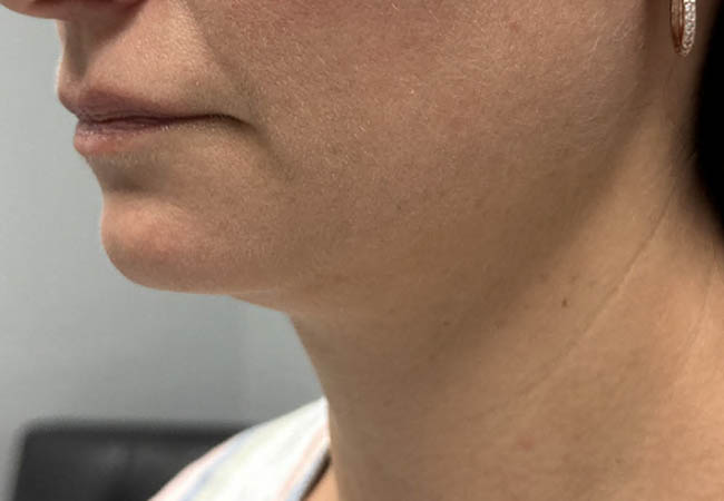 1_0002_Patient 9 before chin and jawline filler 2.PNG