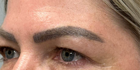 1_0002_patient 4 before upper bleph with temporal brow lift, fat grafting to brows and peri-orbital CO2 (left side).png