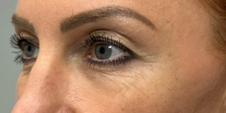 1_0002_patient 40 before upper bleph, ptosis repair and subbrow filler – left side.png