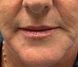 1_0002_patient 9 after lip and corners of mouth filler.png