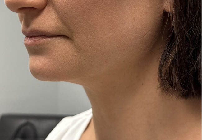 1_0003_Patient 9 after chin and jawline filler 2.PNG