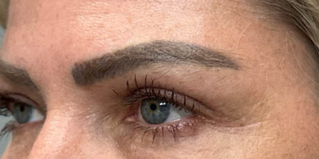1_0003_patient 4 after upper bleph with temporal brow lift, fat grafting to brows and peri-orbital CO2 (left side).png