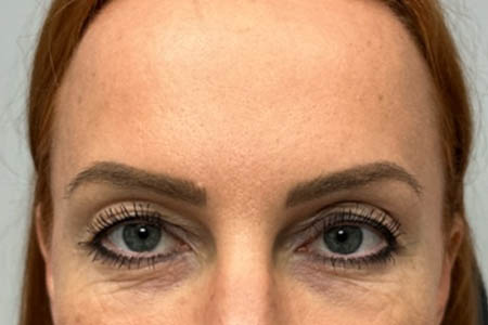 1_0003_patient 40 before upper bleph, ptosis repair and subbrow filler – front.png