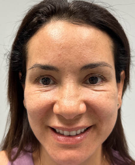 1_0004_patient 14 before dissolving under eye filler- smiling.png