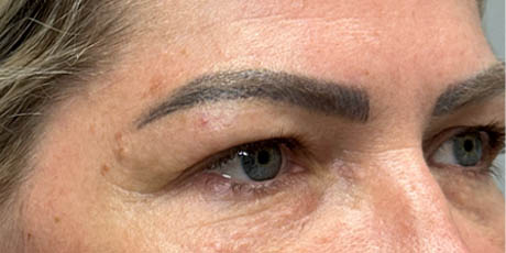 1_0004_patient 4 before upper bleph with temporal brow lift, fat grafting to brows and peri-orbital CO2 (right side).png