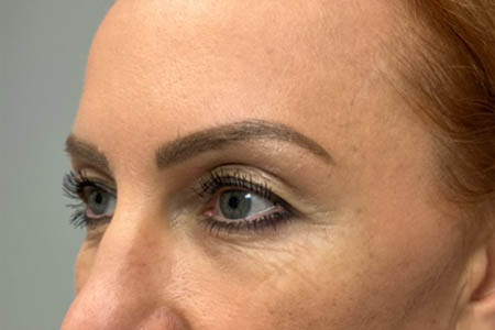1_0004_patient 40 before upper bleph, ptosis repair and subbrow filler – left side.png