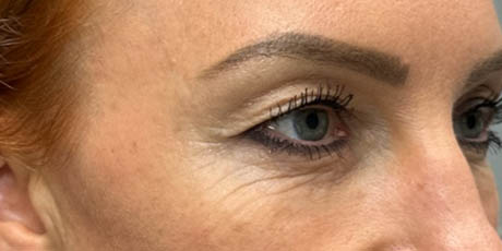 1_0004_patient 40 before upper bleph, ptosis repair and subbrow filler – right side.png
