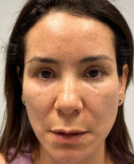 1_0005_patient 14 before dissolving under eye filler.png