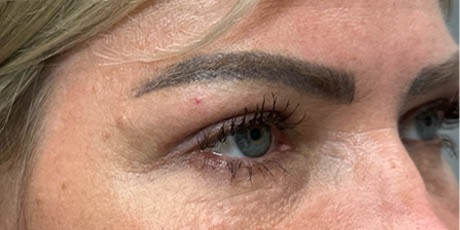 1_0005_patient 4 after upper bleph with temporal brow lift, fat grafting to brows and peri-orbital CO2 (right side).png