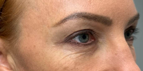 1_0005_patient 40 after upper bleph, ptosis repair and subbrow filler– right side.png