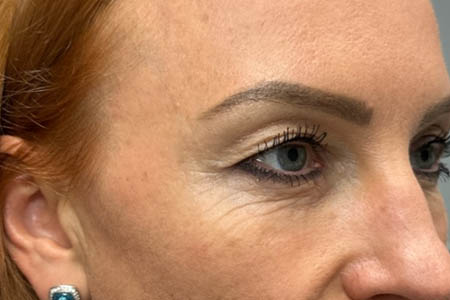 1_0005_patient 40 before upper bleph, ptosis repair and subbrow filler – right side.png