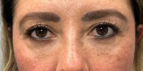 1_0006_patient 88 after upper bleph with subbrow filler.png